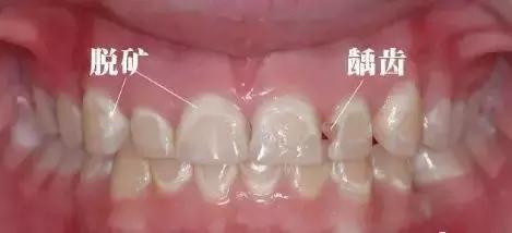 11个月牙齿脱矿龋齿如何补救,龋齿脱矿用含氟牙膏多久有效果