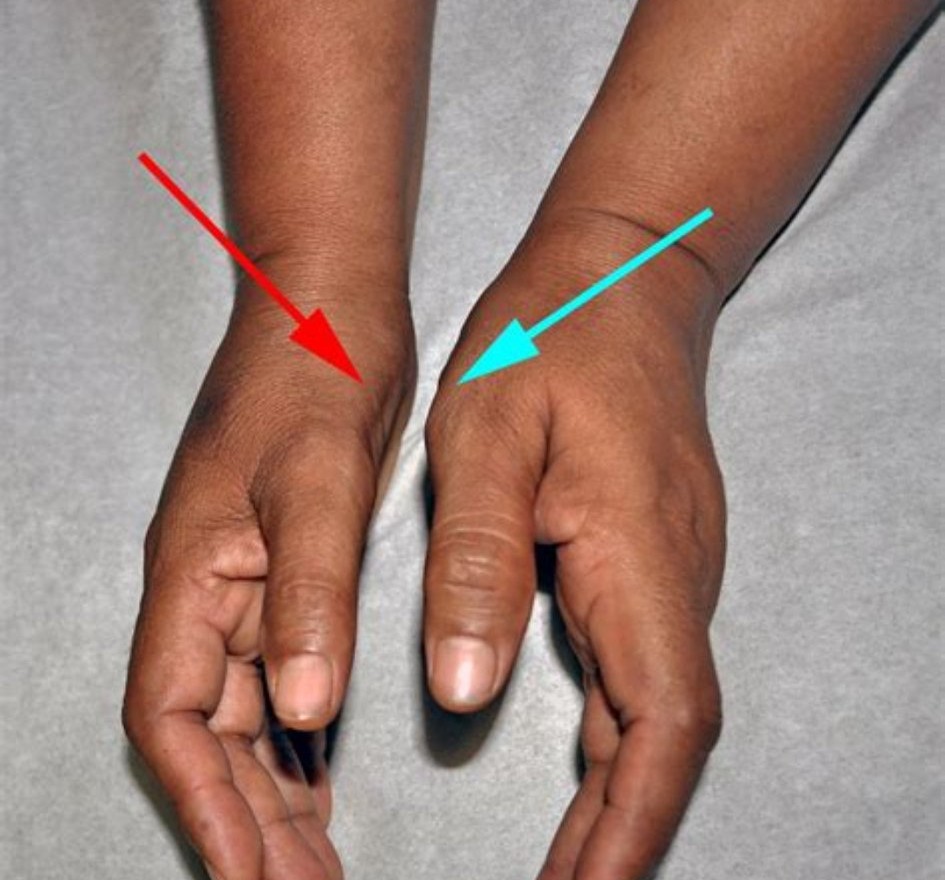 常见麻木病因和治疗方法,手部麻木的7种常见病因