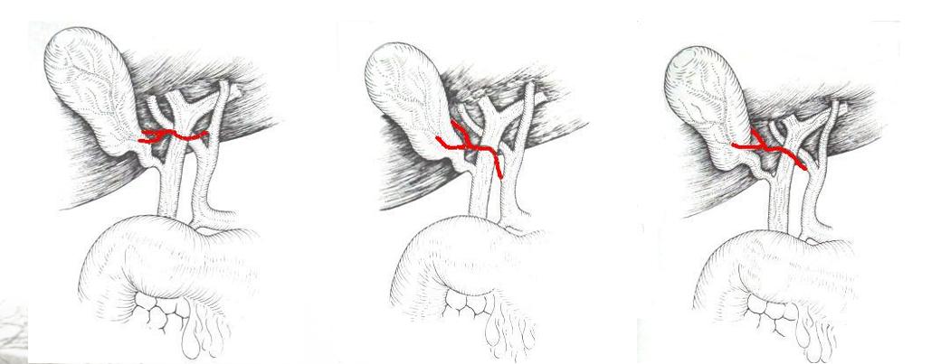 微创胆囊切除后伤口多久彻底愈合,胆囊切除是小手术吗