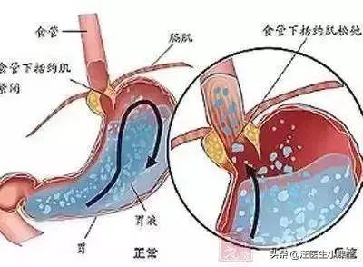 治疗胃食管反流病5招帮您来搞定,通俗易懂的讲胃食管反流病的原因