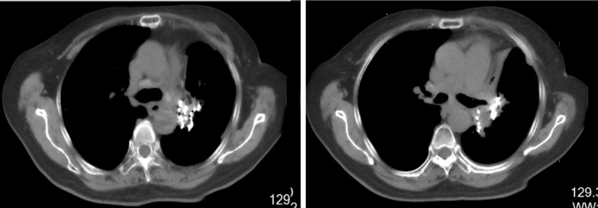 治疗小细胞肺癌的最新方法,小细胞肺癌治疗后成为正常人