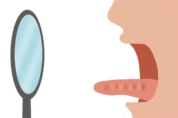 舌苔厚腻两边有齿痕怎么回事,舌苔厚腻齿痕重可以吃逍遥丸吗