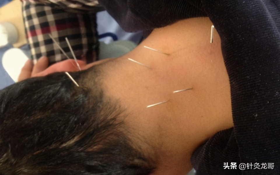 富贵包针灸和小针刀哪个效果好,富贵包可以针灸吗有什么效果