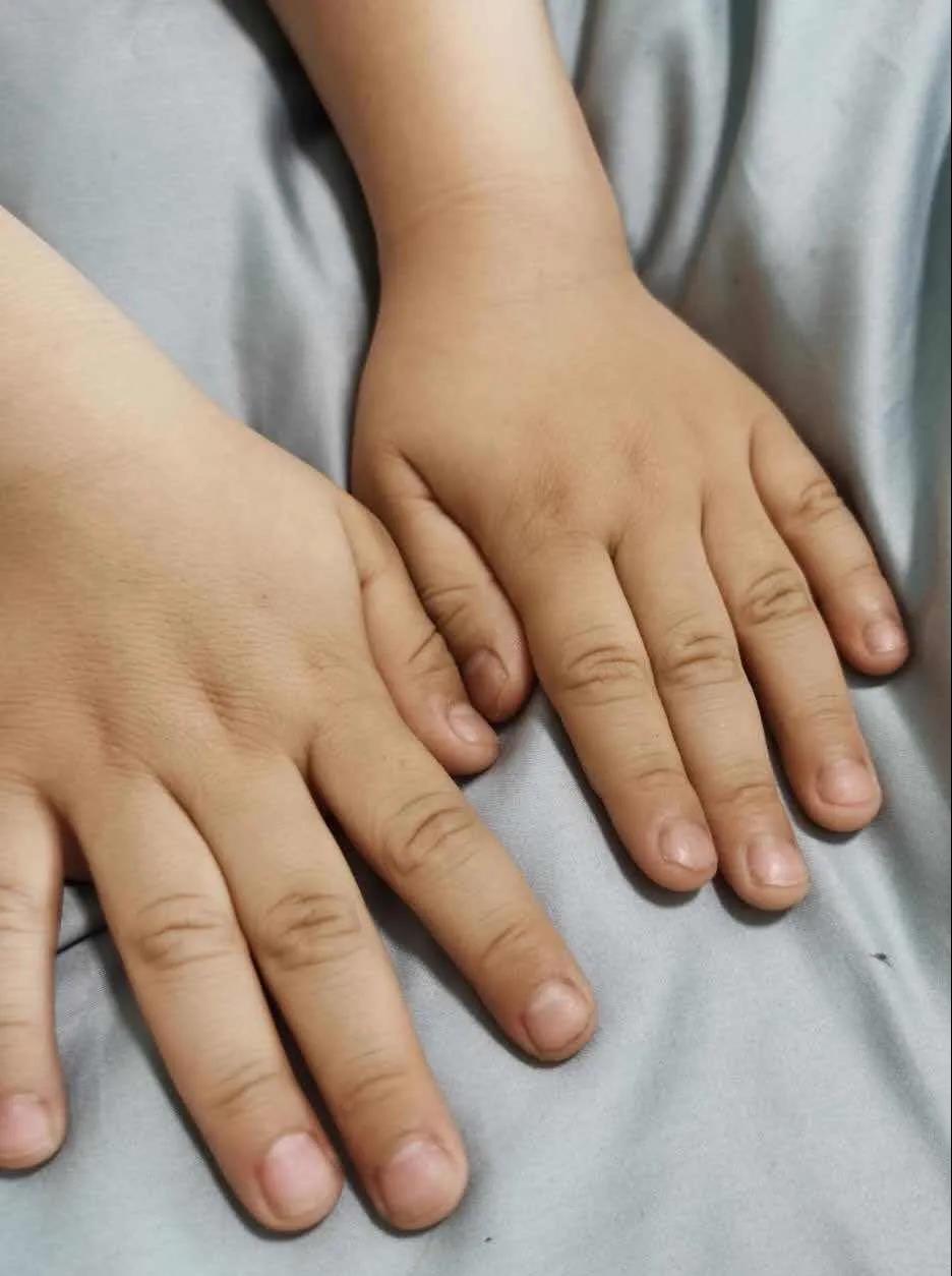 冬季指甲皲裂起皮,指甲变薄是真菌感染的哪种