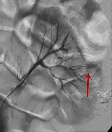 一产妇手术台上大出血死亡,一产妇大出血急需血小板去世