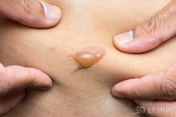 儿童烧伤烫伤医生教你急救五步走,孩子烫伤破皮几天能结痂