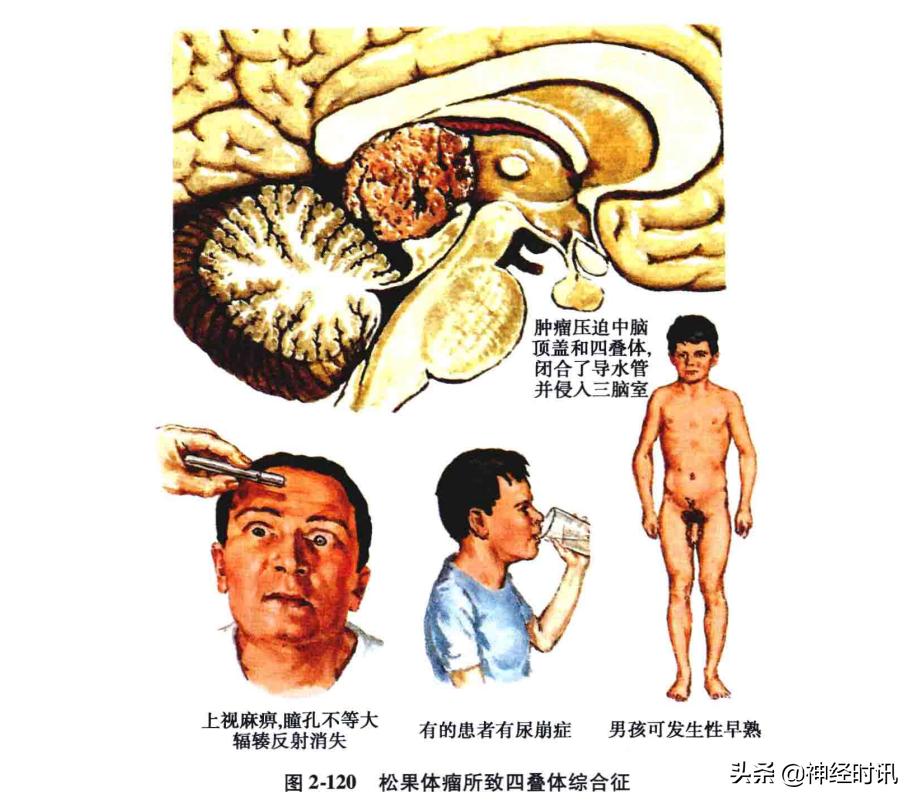 脑干解剖,脑干神经解剖