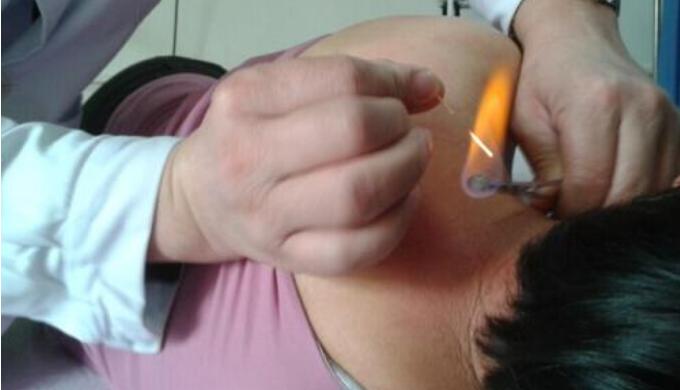 火针治疗淀粉样皮肤病有效吗,引火烧身免费全文