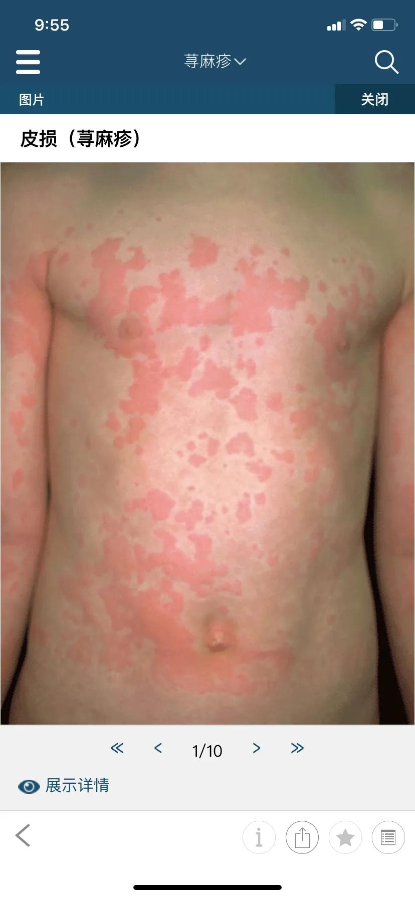 儿童荨麻疹反复发作三招教你搞定,慢性儿童荨麻疹最简单自愈方法