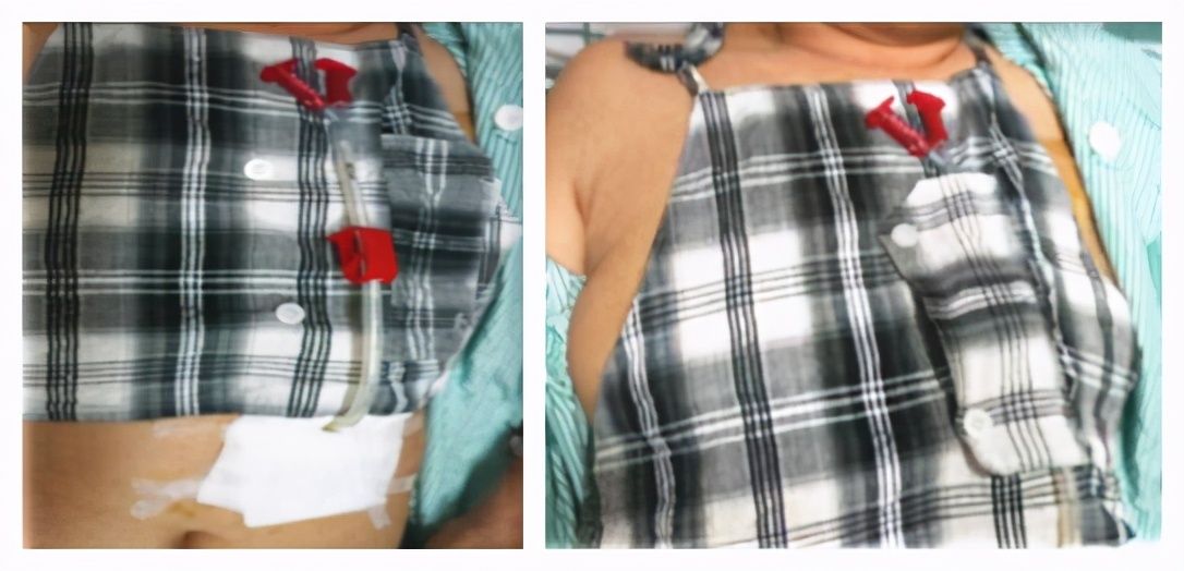 做了胃瘘手术能用嘴吃饭吗,做好这四件事让胃更健康