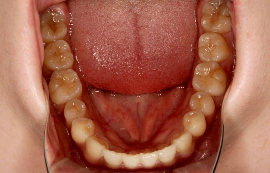 西安张军正畸医生如何,西安牙齿矫正案例