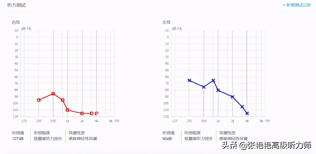 戴上人工耳蜗的大孩子,小孩第一次戴人工耳蜗反应