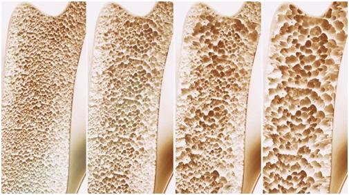 血钙含量和骨质疏松有关吗?