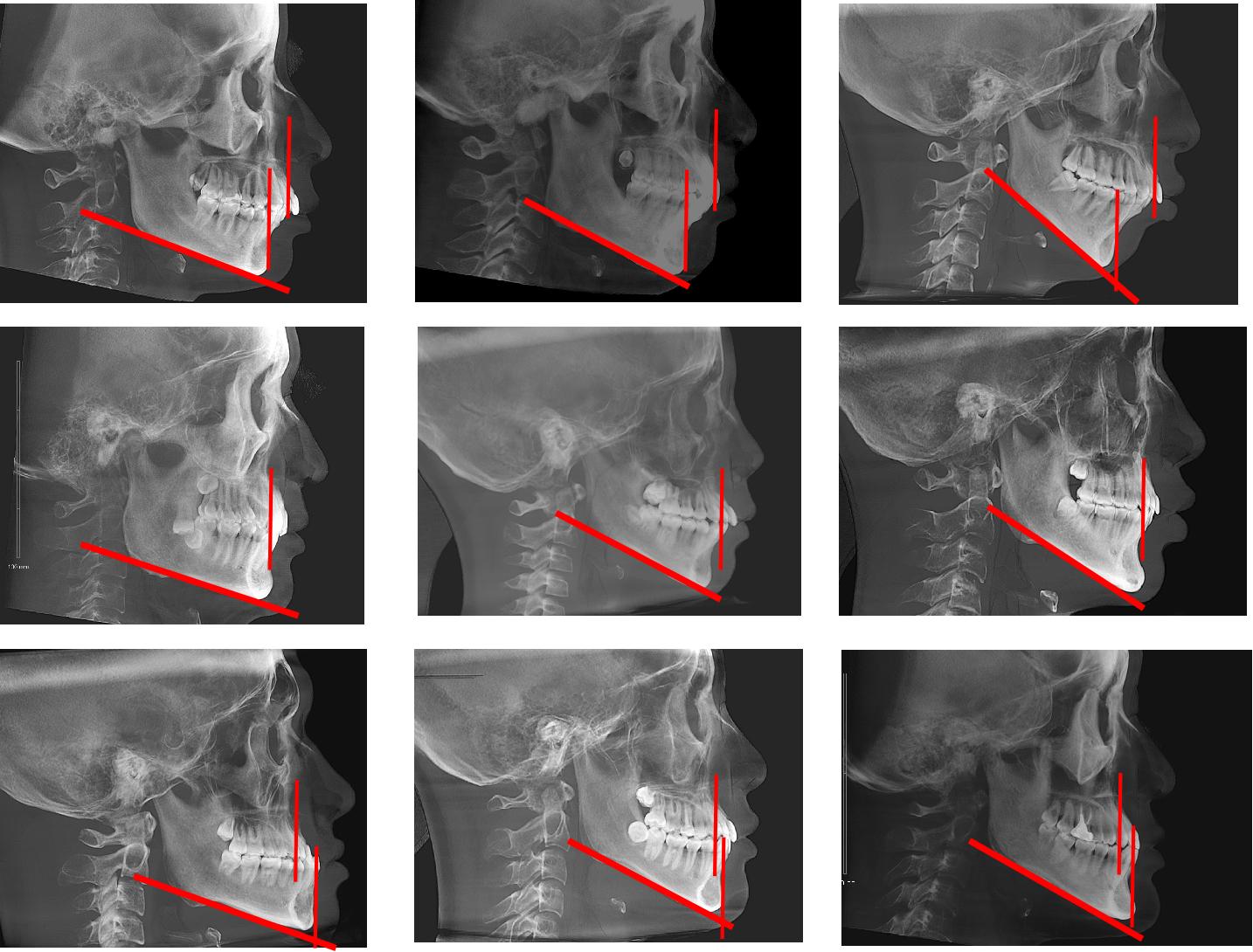 华晨宇的下巴,削下颌骨的华晨宇