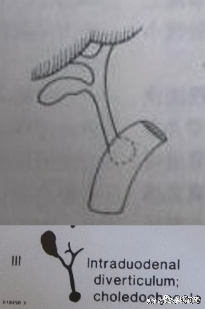 胆总管变异,胆胰管解剖