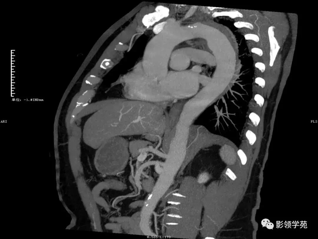 主动脉壁间血肿护理查房,主动脉夹层和壁间血肿图片