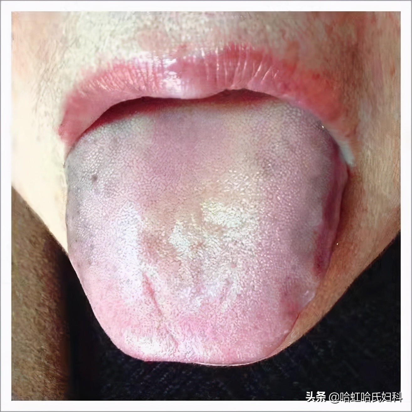 中医的五种方式告诉你是否脾虚,一招教您判断体内湿气