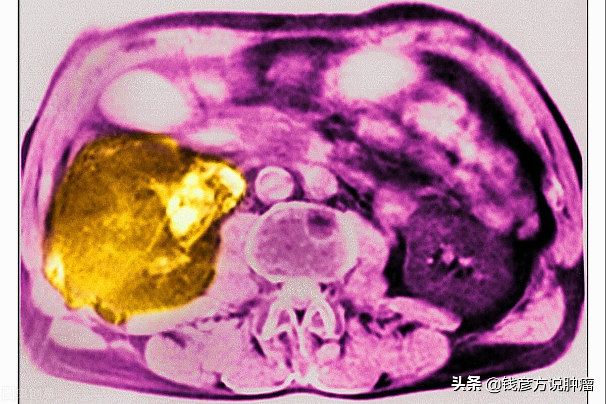 15公分大的肝肿瘤，增加到18公分，但是却战胜了肿瘤，为什么？