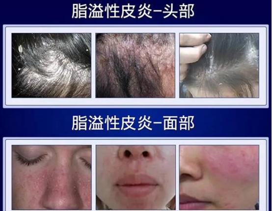 头皮有血疙瘩是什么病,头皮长疙瘩怎么回事怎么解决