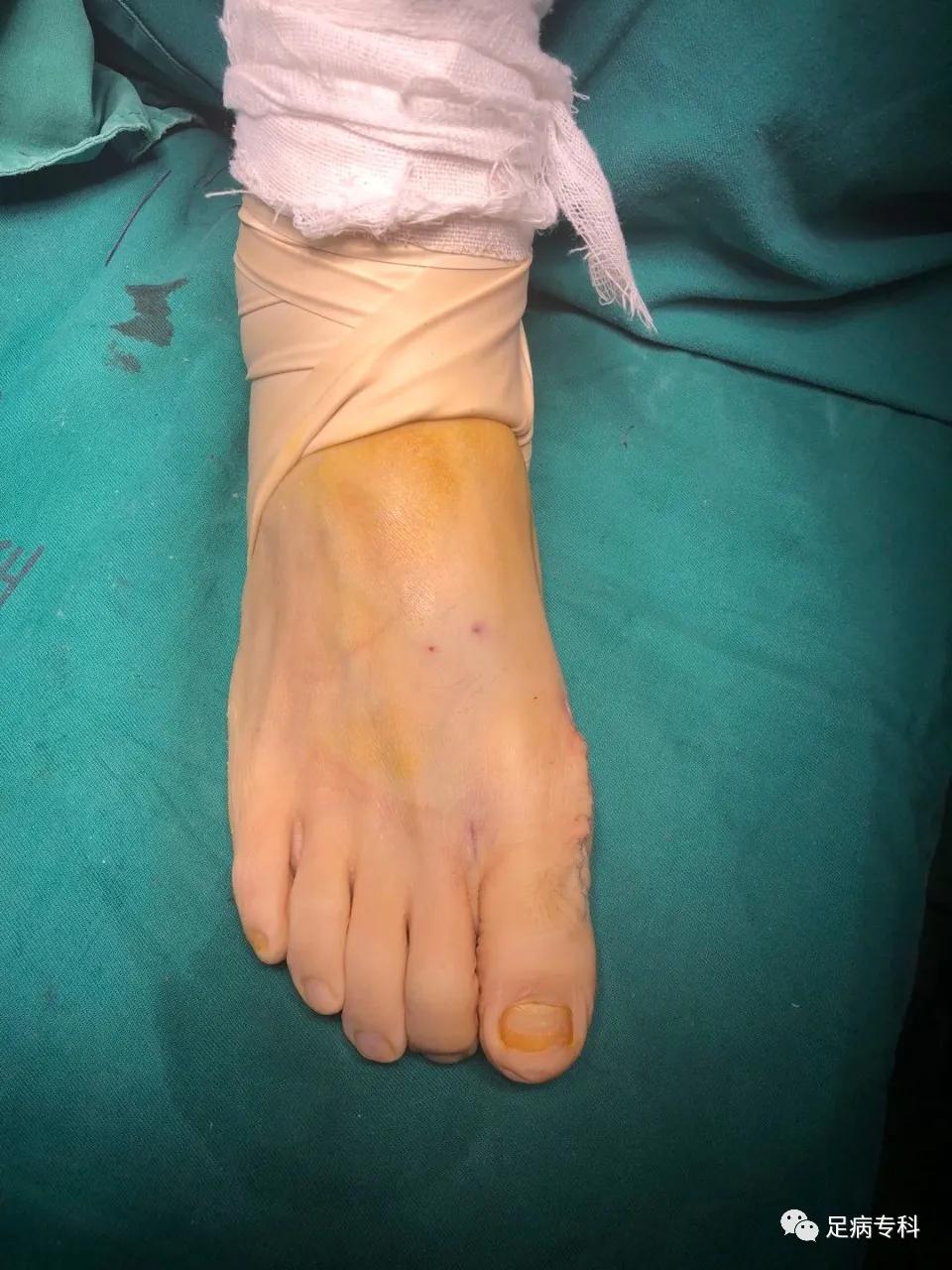 拇外翻微创手术的全过程,医生自己给自己做拇外翻手术