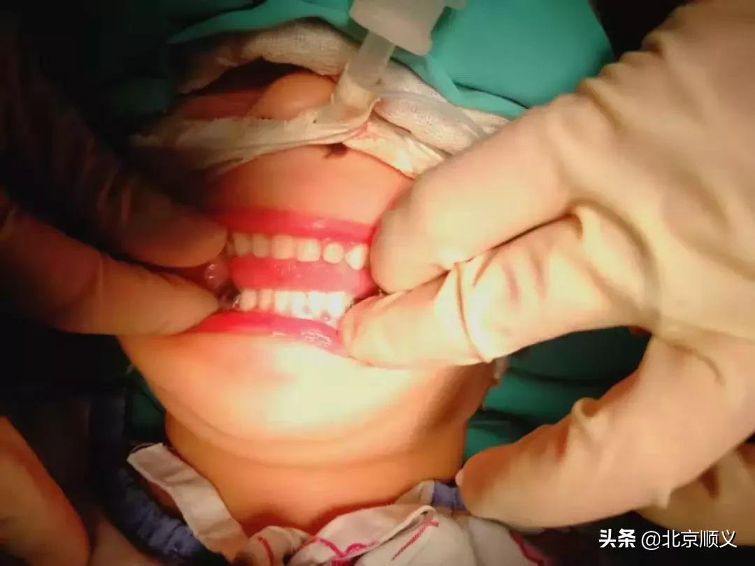 顺义儿童牙科治疗医院,顺义儿童补牙