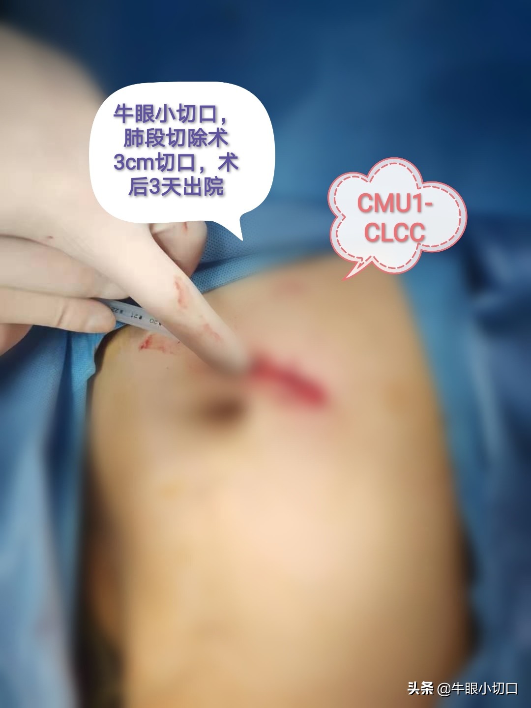 磨玻璃影肺腺癌切除最佳时机,肺磨玻璃结节ggo和ggn各表示什么