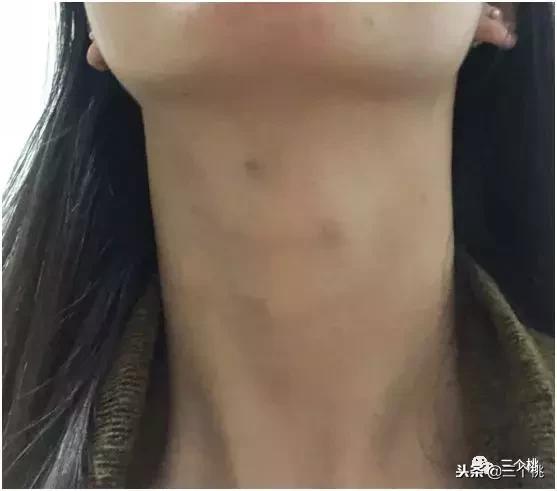 医美去颈纹全过程,去颈纹医美过程