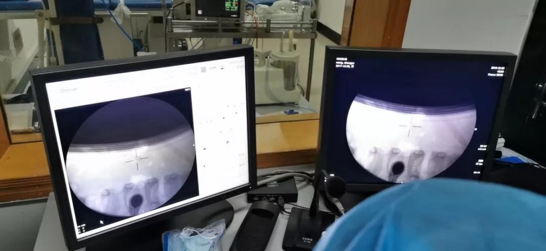 小儿尿道结石如何碎石,小儿尿结石