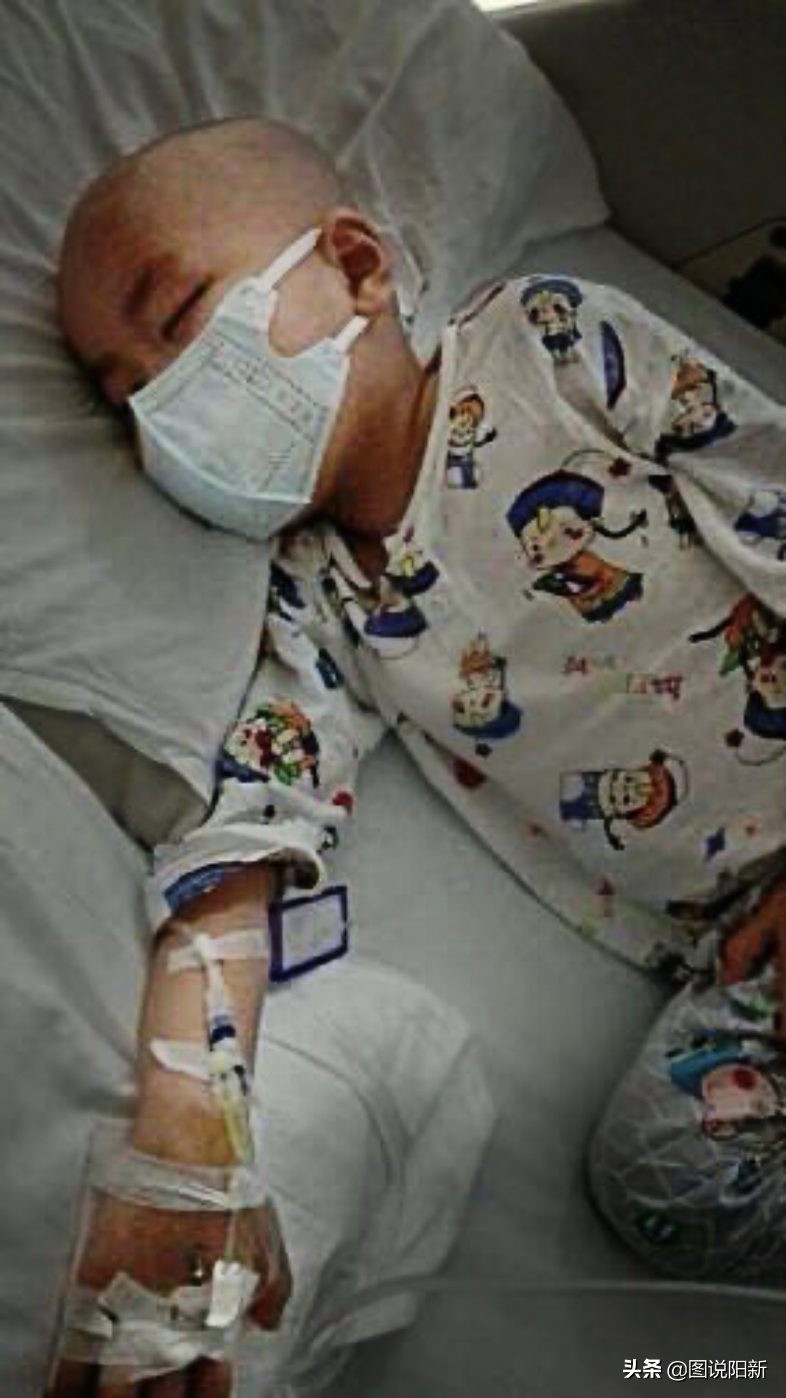 肿瘤儿童化疗期间脑萎缩,化疗后脑萎缩变傻了