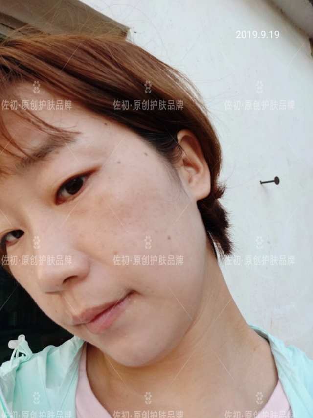 生完孩子烂脸,生完孩子脸上垮了怎样处理