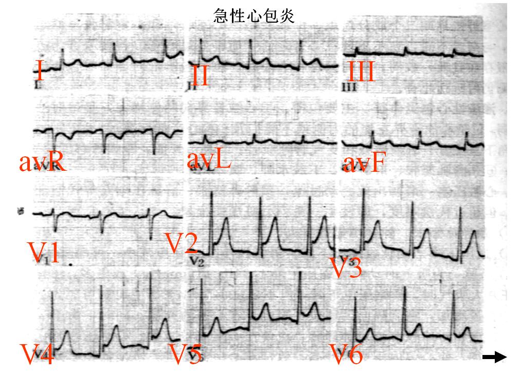 急性心肌梗死的做法,内科主治心肌梗死视频