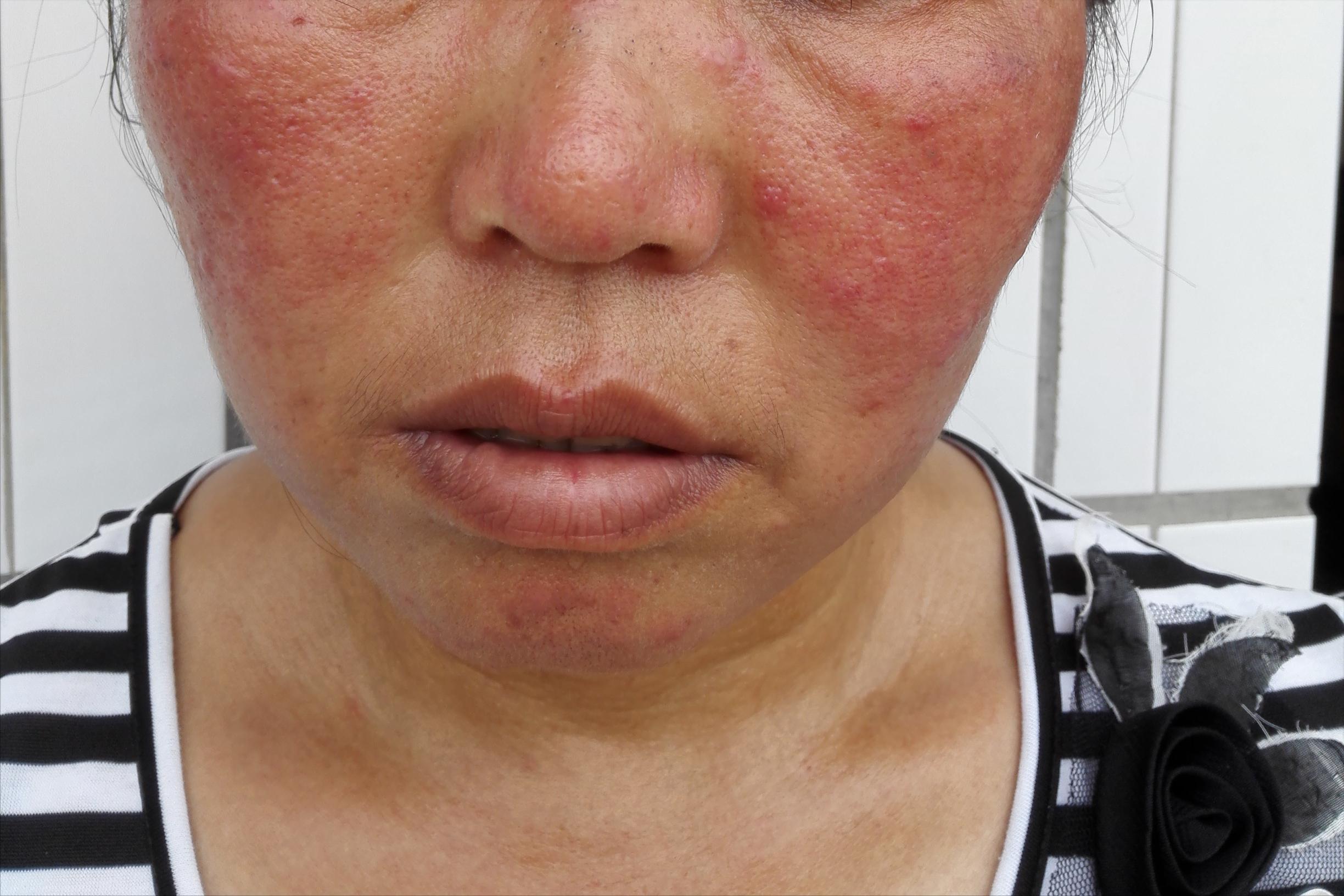 脸部皮炎使用激素药膏可以吗,医用护肤品修复激素依赖性皮炎