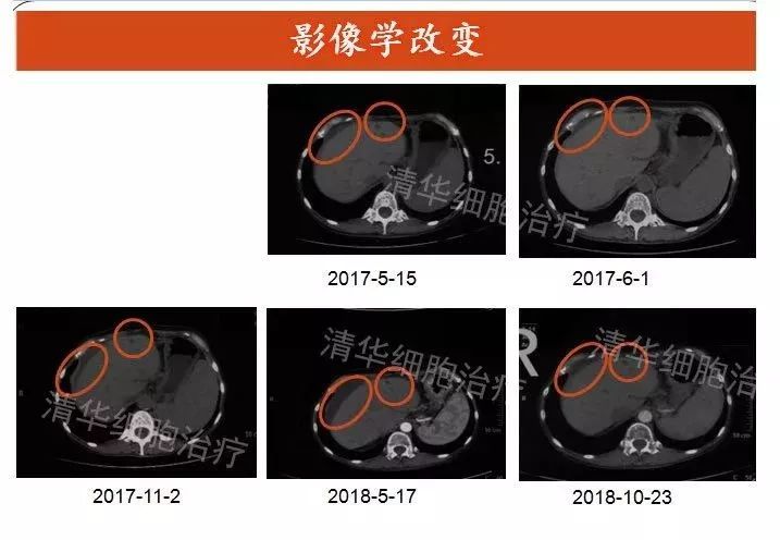 nkt治疗对什么肿瘤有效,nkt治疗适合哪种癌症