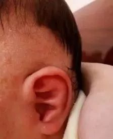 出生宝宝耳朵耳廓畸形判断,新生婴儿耳廓畸形圆耳