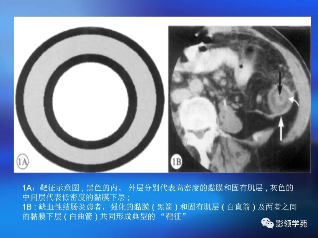 肠道内壁增厚,肠道扩张ct表现