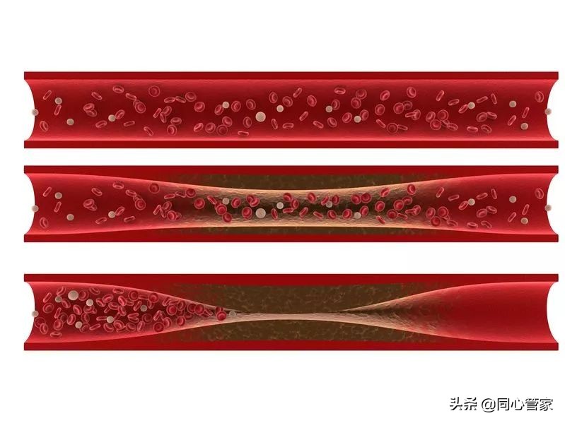 服用阿司匹林可以防止血管钙化,血管堵吃阿司匹林