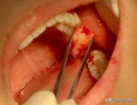 智齿牙龈肿痛下颌淋巴结肿痛,智齿肿痛是怎么回事