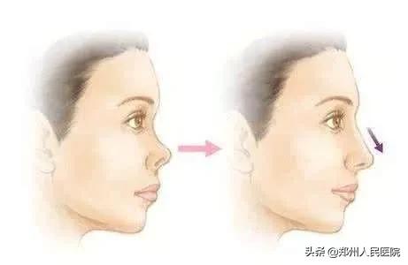 鼻子变好看的方法速成,让鼻子变好看图集