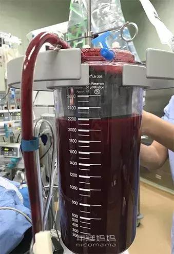 比意外怀孕更可怕的，就是宫外怀孕了