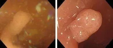 做肠镜之前清肠的亲身经历,清肠几个小时以后做肠镜最合适