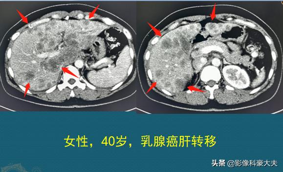 22岁查出癌症放弃治疗,医生自述得癌症放弃治疗