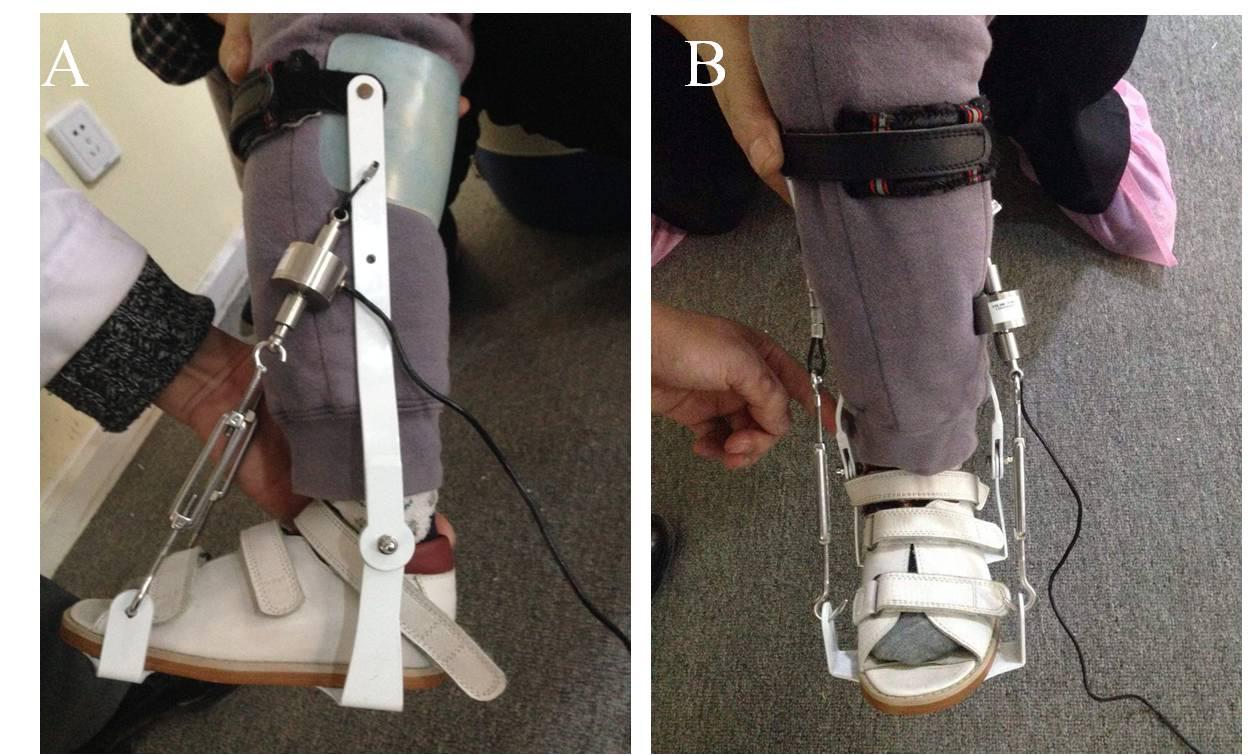 孩子足外翻买什么鞋矫正,儿童足外翻矫正鞋去哪里做