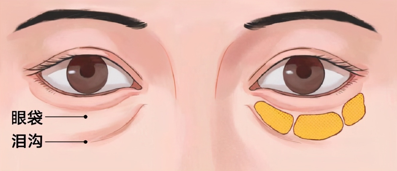 黑眼圈眼袋要睡多长时间,为什么早睡眼袋黑眼圈还是很严重