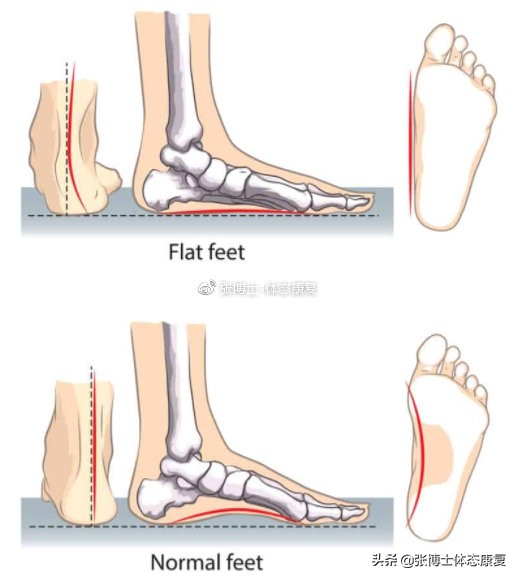 功能性扁平足对体态有什么影响,女生扁平足带来的体态改变