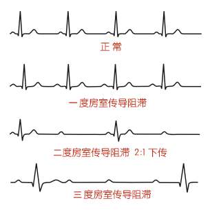 什么容易引起房室传导阻滞,房室传导阻滞什么病
