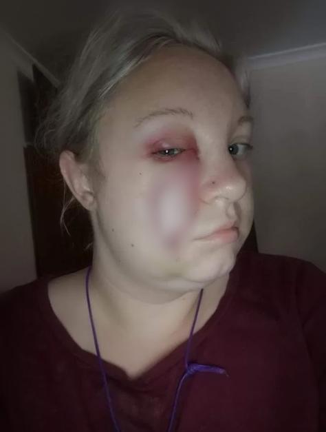 5岁女孩长水痘,成年人长水痘留下红印