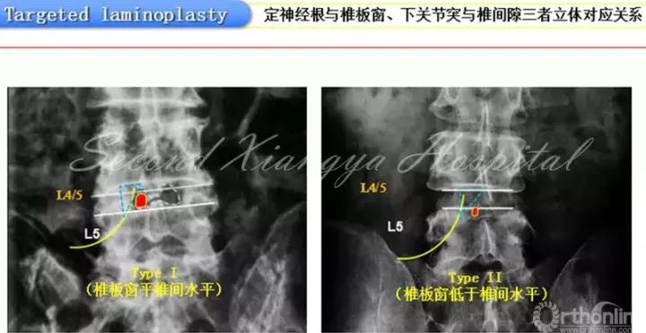 经皮腰椎间盘切除术有何优缺点,什么是经皮内镜腰椎手术