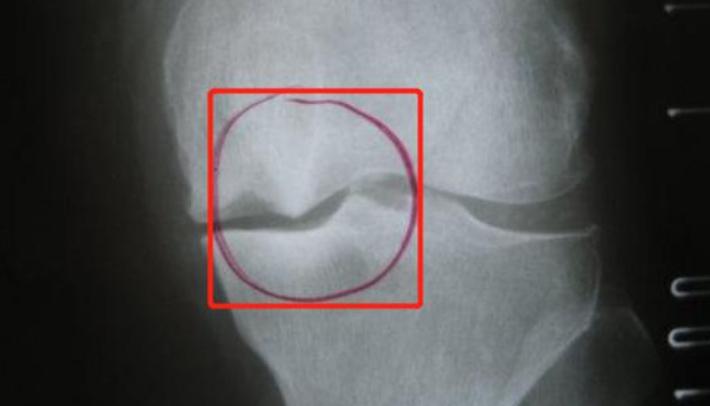 浏阳骨科医院治骨质增生吗,骨质增生查什么