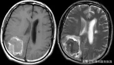 脑出血磁共振各个时期表现,脑出血的分期及磁共振影像学表现