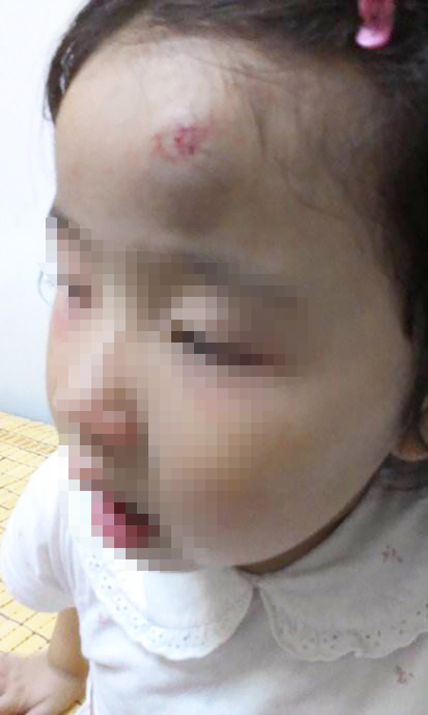 孩子摔倒后额头磕个大包怎么处理,女儿摔到脑袋